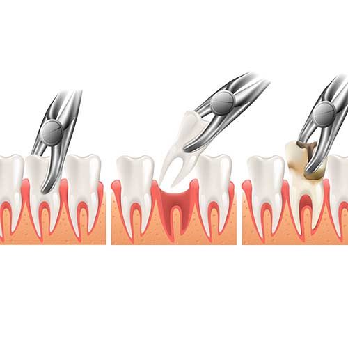 Tooth-Extractions1