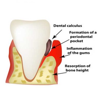 periodontal