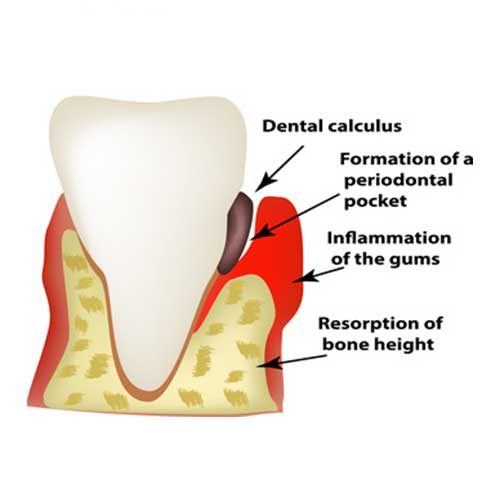 periodontal